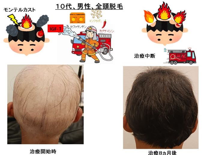 円形脱毛症　病院